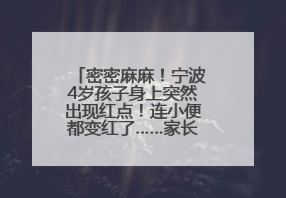 密密麻麻！宁波4岁孩子身上突然出现红点！连小便都变红了……家长：以为只是摔伤
